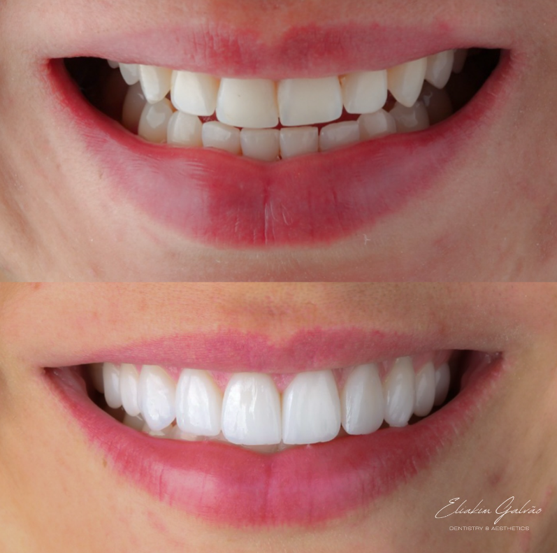 Sorriso com lentes de porcelana planejadas na clínica (1)
