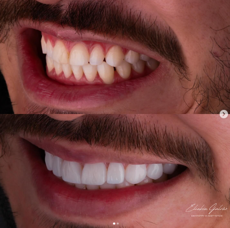 Sorriso com lentes de porcelana planejadas na clínica (2)