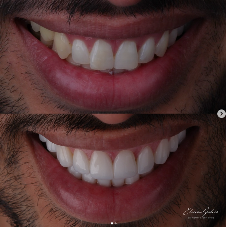 Sorriso com lentes de porcelana planejadas na clínica (3)