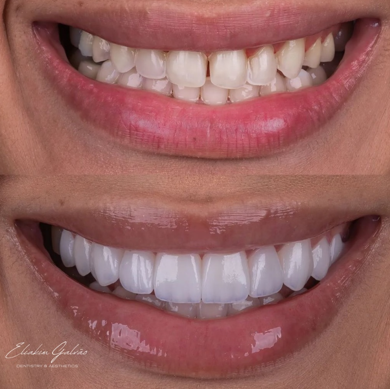 Sorriso com lentes de porcelana planejadas na clínica (4)